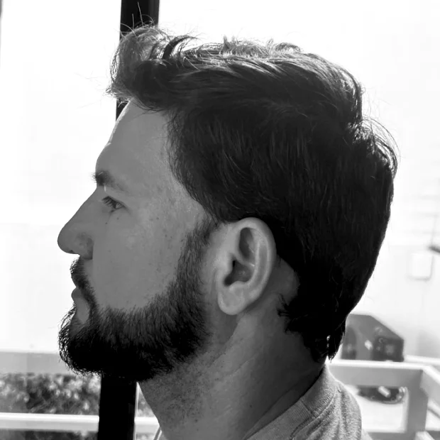 Transplante Capilar de Barba - Depois